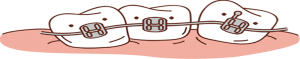 Braces
